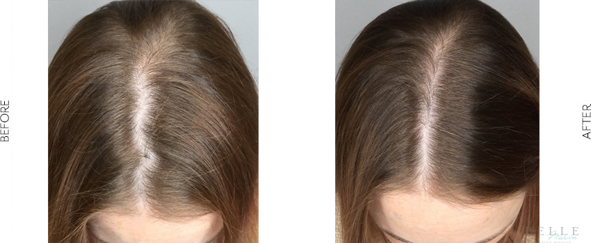 Before and After Image: PRP Hair Restoration - front