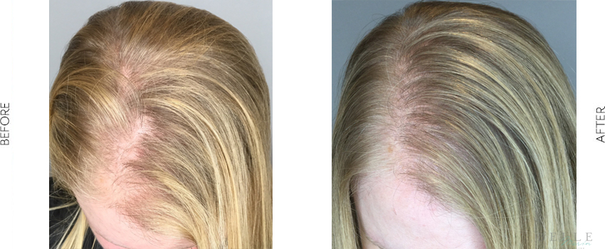 Before and After Image: PRP Hair Restoration - left-front-oblique