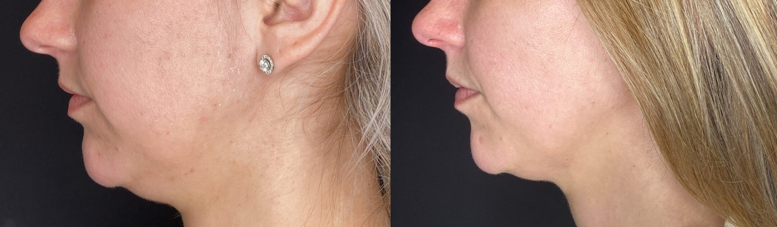 Before and After Image: Body Contouring - left-side