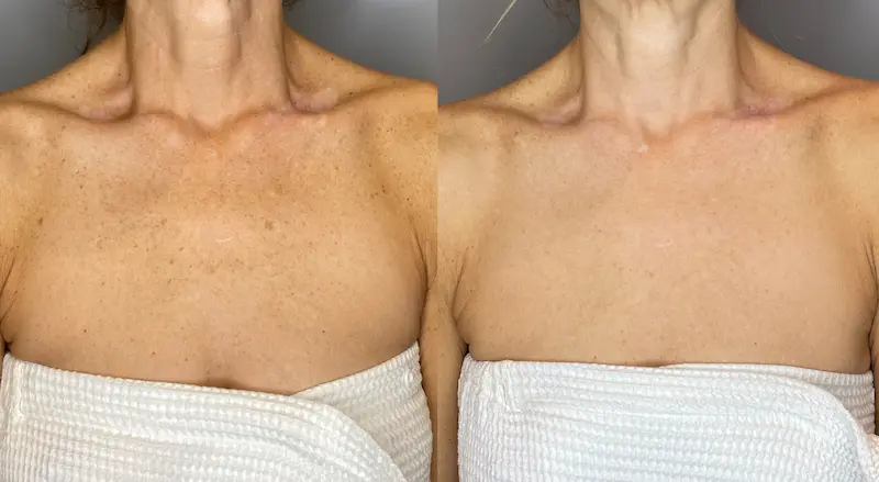 Before and After Image: BBL - front