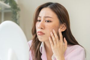 A woman with melasma looking in the mirror and considering Tixel®